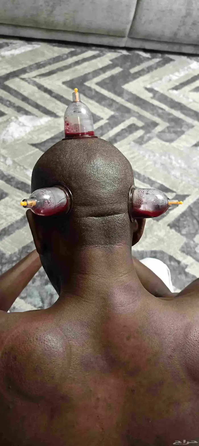 متخصص حجامة منزلية خبرة اكثر من 5 سنوات 9