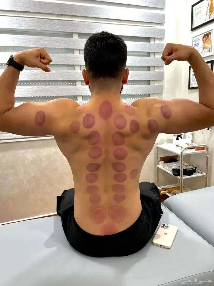 حجامه منزليه علاجية ووقائيه 3