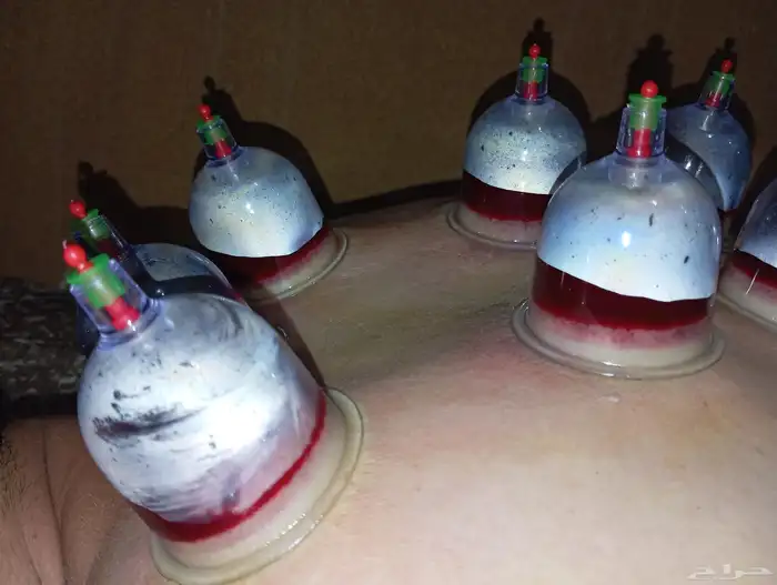 الحجامه النبويه الشريفه   كل انواع الحجامه 5