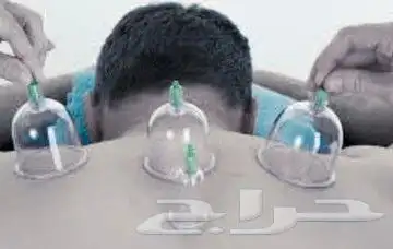 hijama for you and your family 1