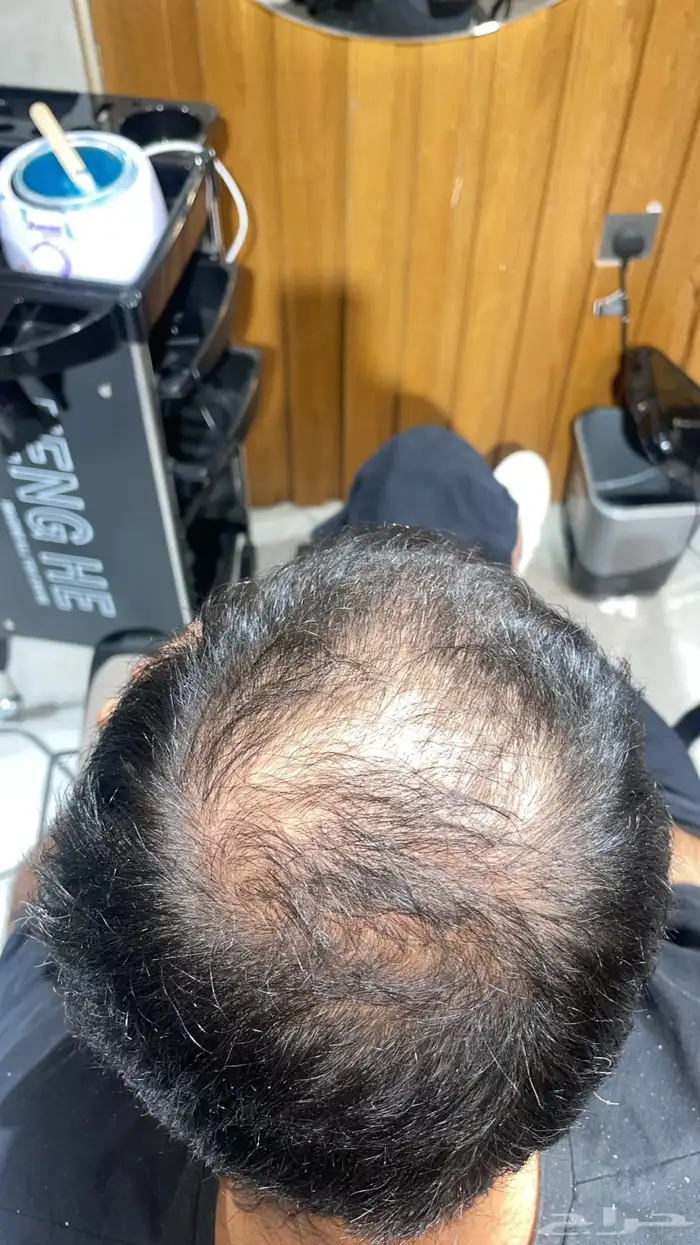 تركيب شبكيات شعر طبيعي بجوده عاليه 13