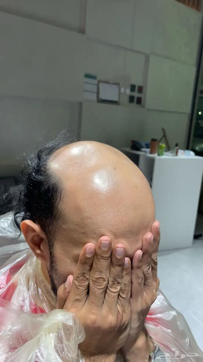 تركيب شبكيات شعر طبيعي بجوده عاليه 7