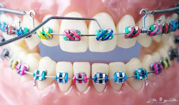 تقويم اسنان زينه 10