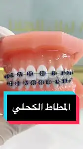 تقويم اسنان زينه 7