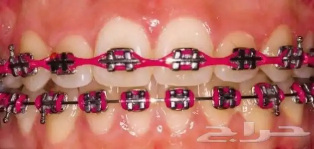 تقويم اسنان زينه 6