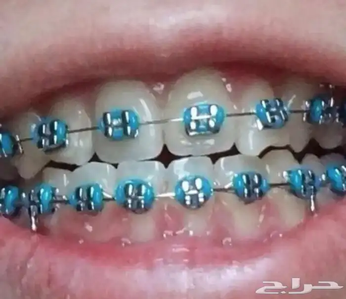 تقويم اسنان زينه 8