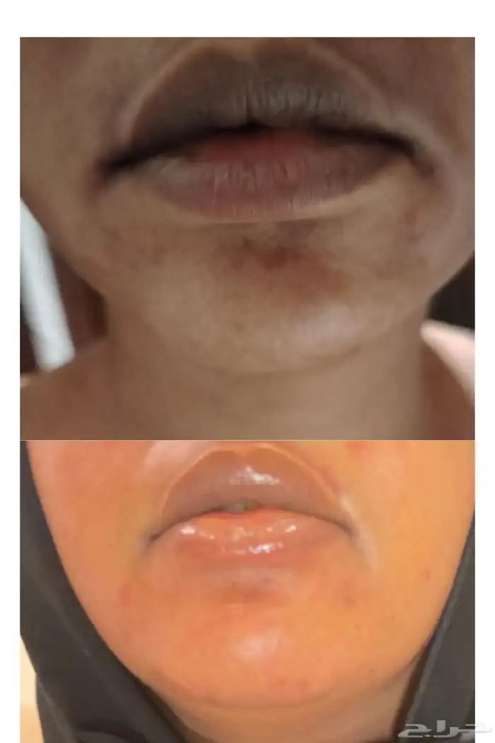 عرض على تفتيح وتوريد الشفايف ب 500 ريال 0