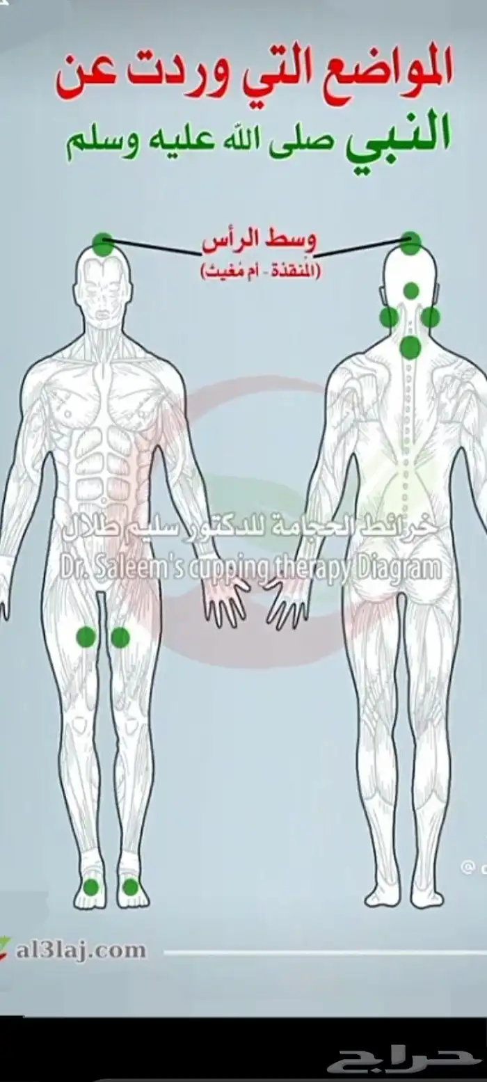 الحجامة النبوية بطريقة طبية علمية 0