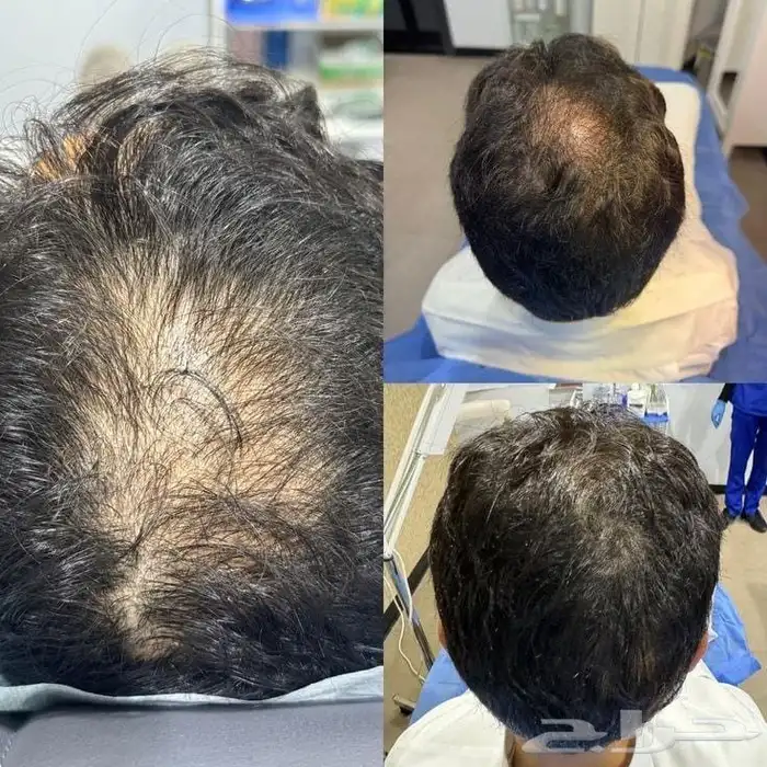 تبغى حل لتساقط الشعر والفراغات الخل عندى حياك راسلني خاص 0