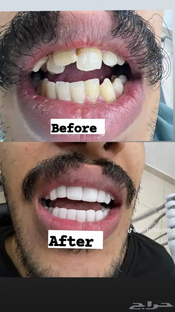 عروض اسنان 0