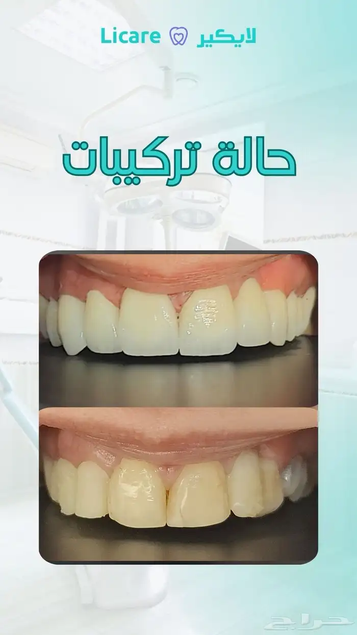 عروض اسنان 1