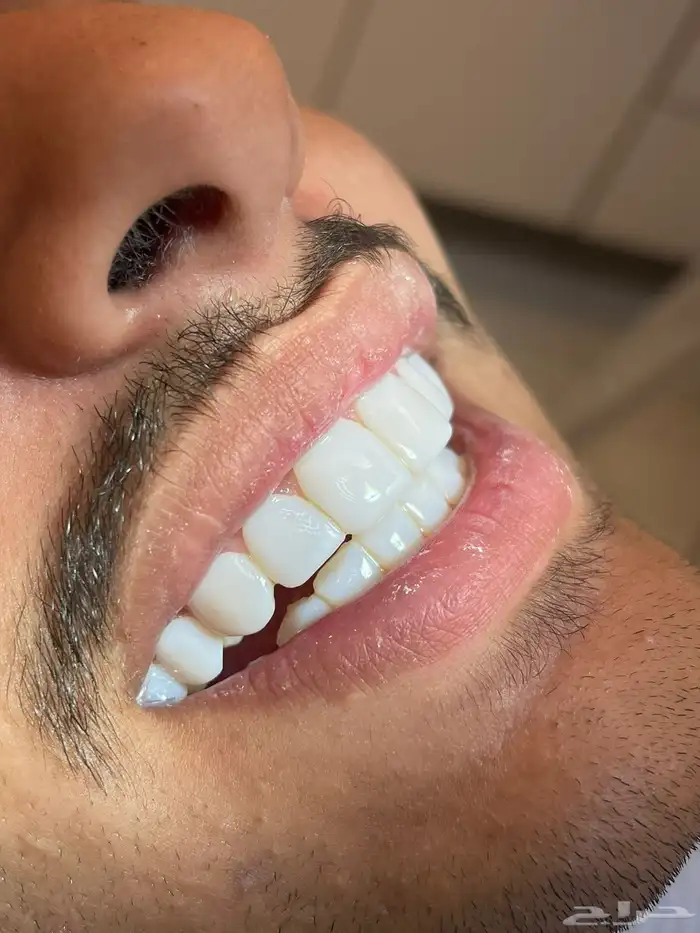 ابتسامه هواليود سمايل 0