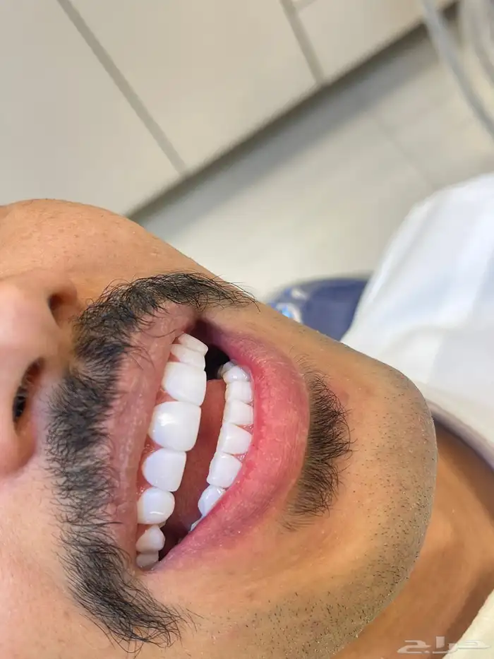 ابتسامه هواليود سمايل 5