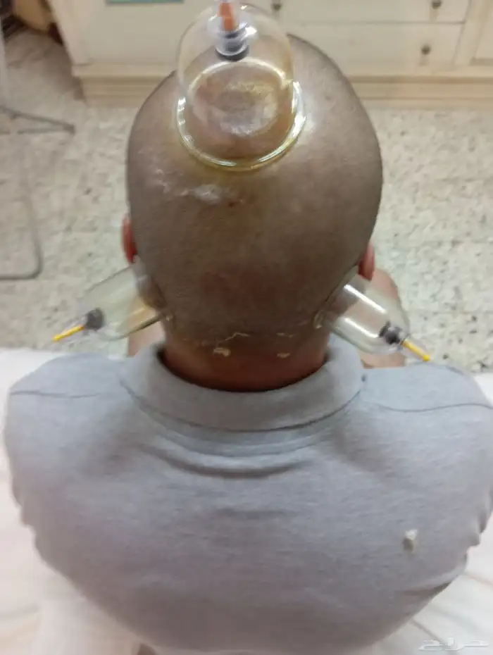 حجامه طبيه على السنه النبويه 6