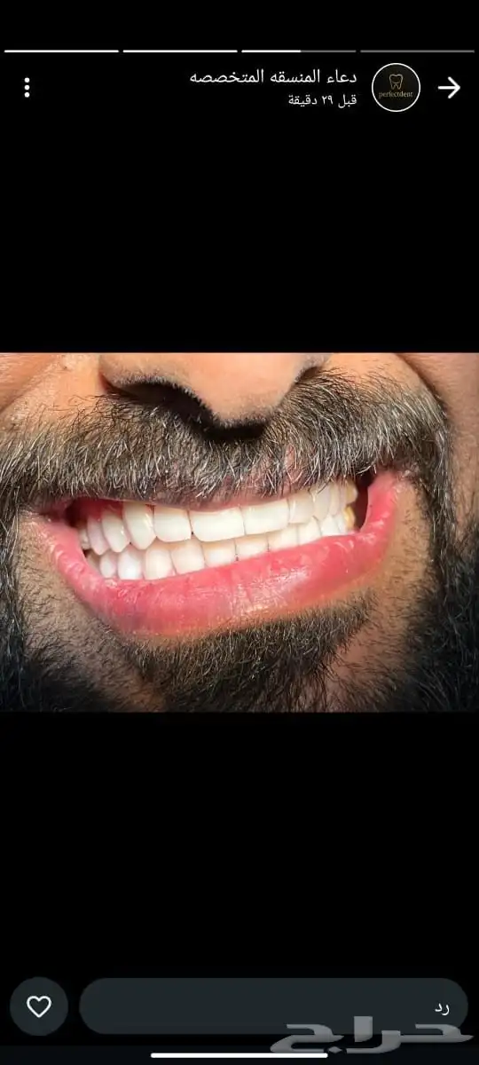 ابتسامه هواليود سمايل 1