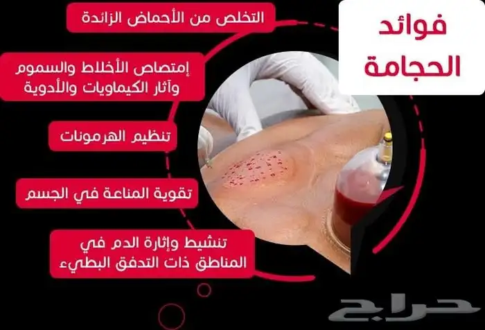 متخصص حجامة 0