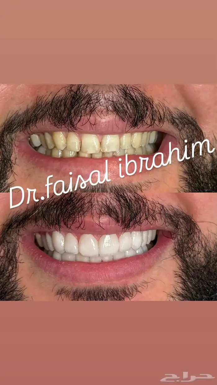 ابتسامه هواليود سمايل 6