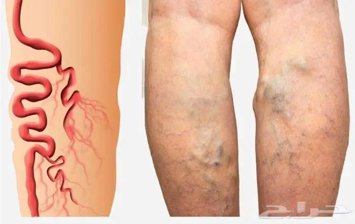 زيت دوالي الخصية والساقين 1