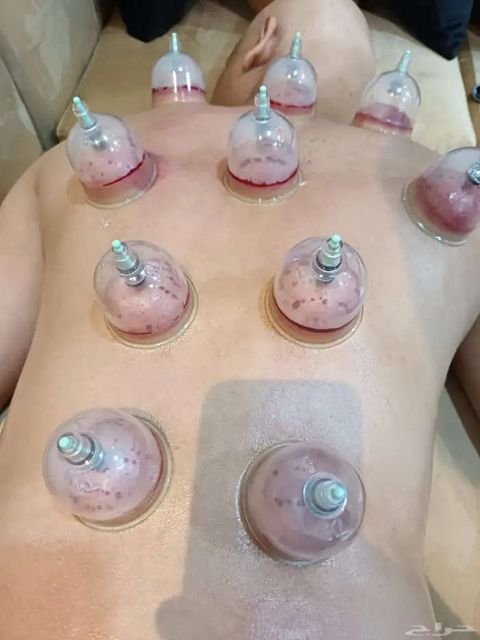 متخصص حجامة منزلية خبرة اكثر من 5 سنوات 0