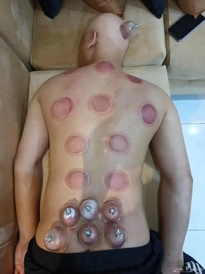 متخصص حجامة منزلية خبرة اكثر من 5 سنوات 2