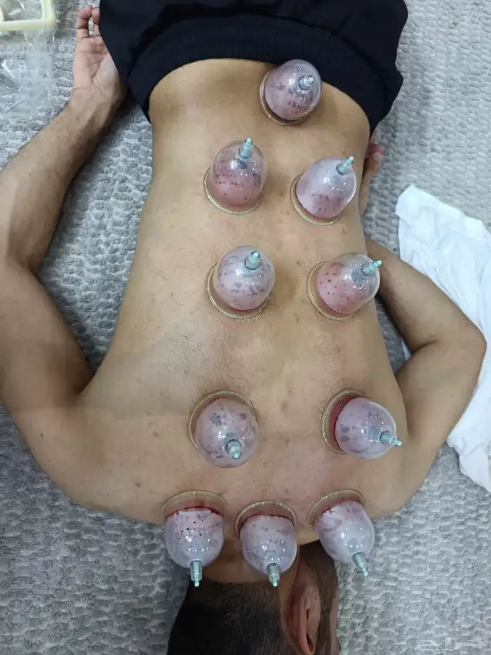 متخصص حجامة منزلية خبرة اكثر من 5 سنوات 9