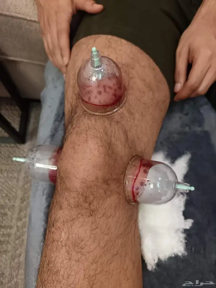متخصص حجامة منزلية خبرة اكثر من 5 سنوات 7