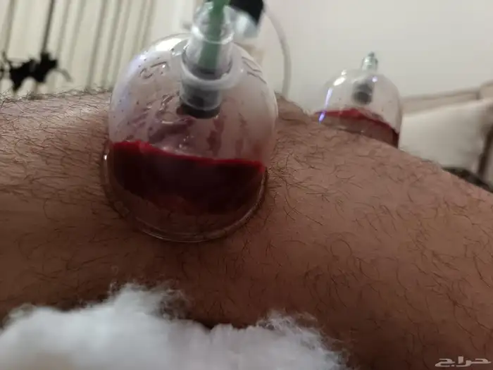 متخصص حجامة منزلية خبرة اكثر من 5 سنوات 8