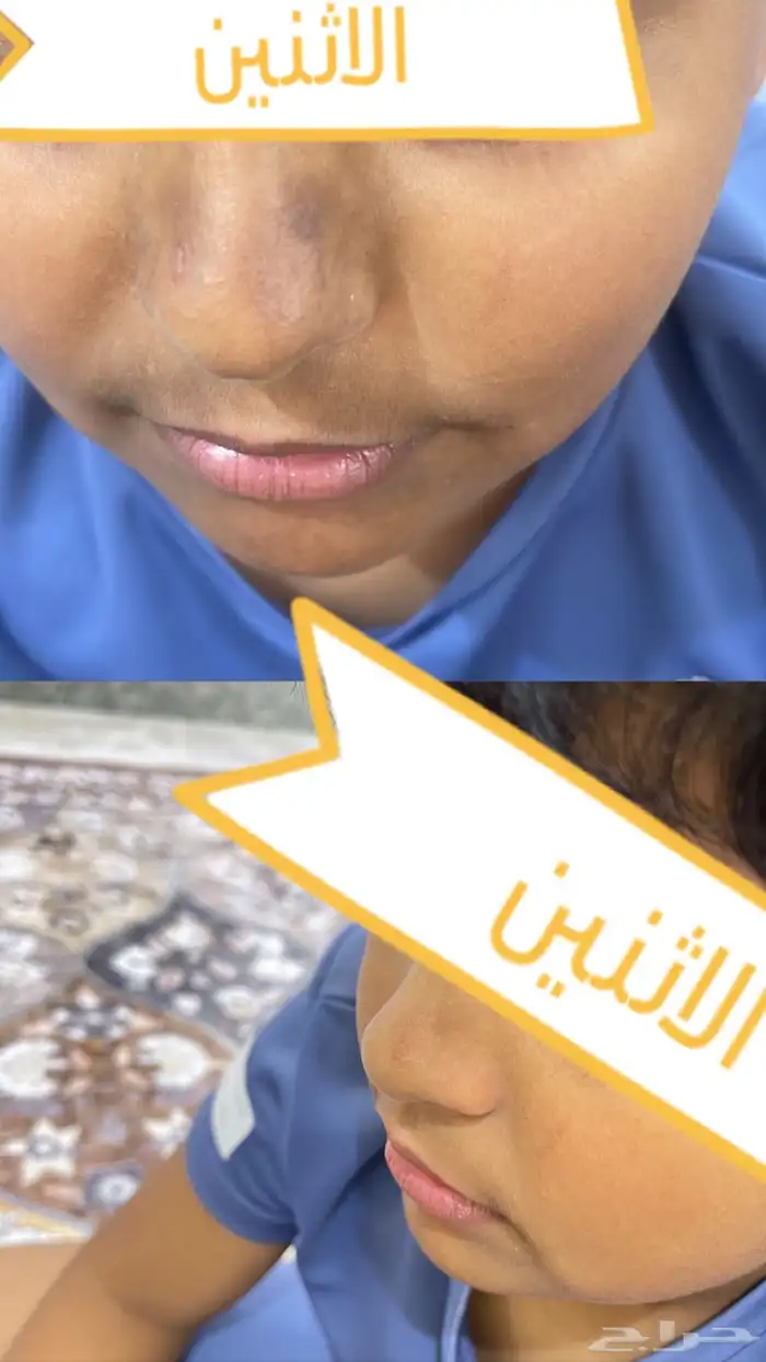 تبييض البشره وازالة التصبغات 6