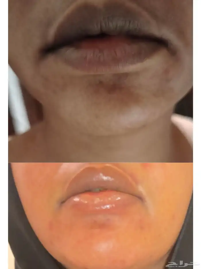 تفتيح وتوريد الشفايف ب تقنية المايكرو وألوان ع ضويه طبيعيه 0