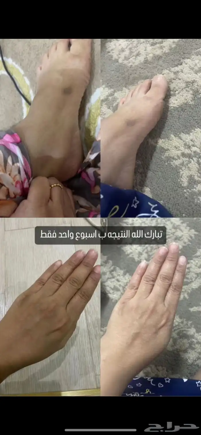 تبييض البشره وازالة التصبغات 7