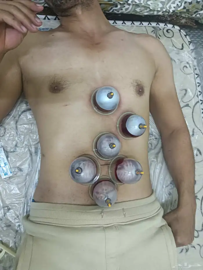 الحجامة النبوية بالمدينة المنورة 0