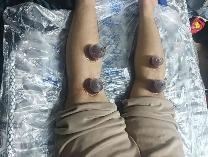 الحجامة النبوية بالمدينة المنورة 3