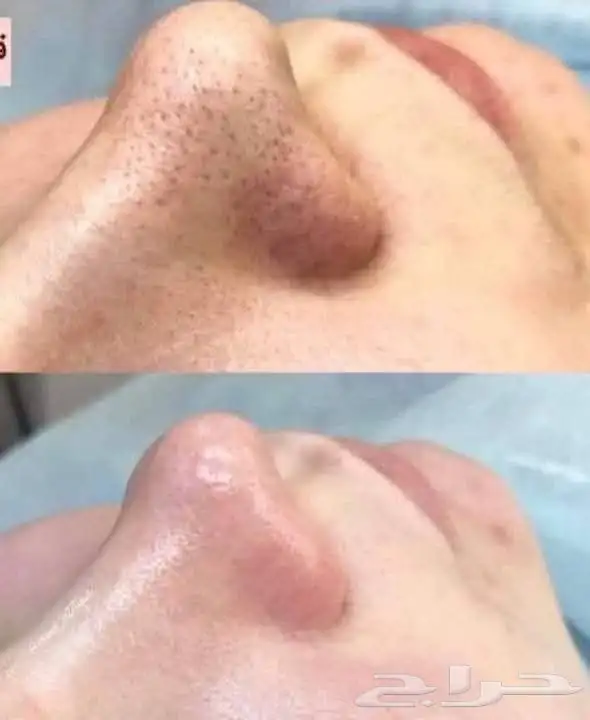 نظيف بشرة ميكروبليدنج. توريدشفايف 5