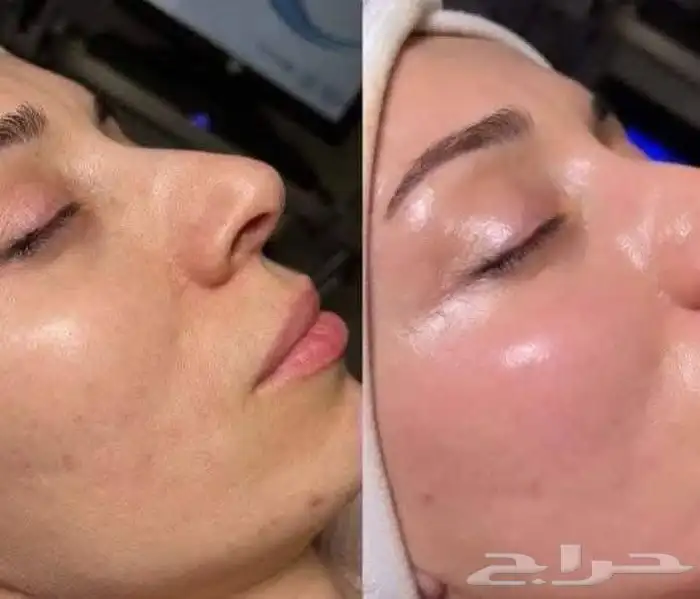 نظيف بشرة ميكروبليدنج. توريدشفايف 4