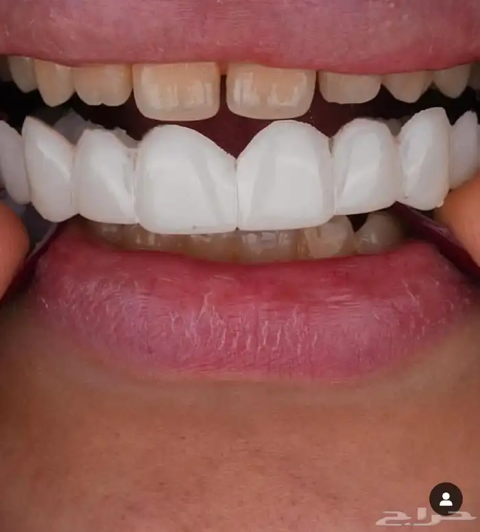 ابتسامة هوليود 4