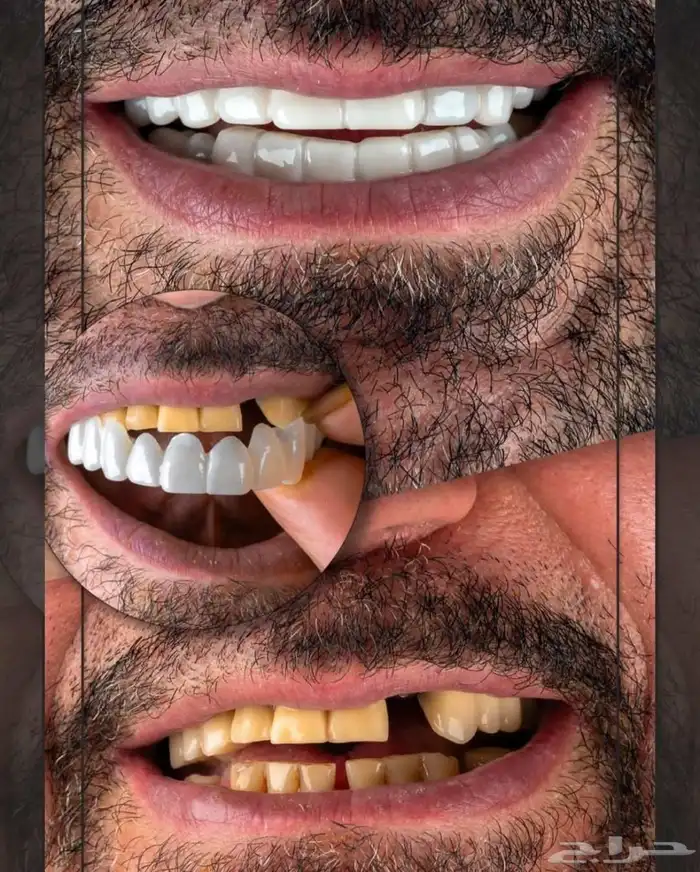 ابتسامة متحركة تجميلية 2