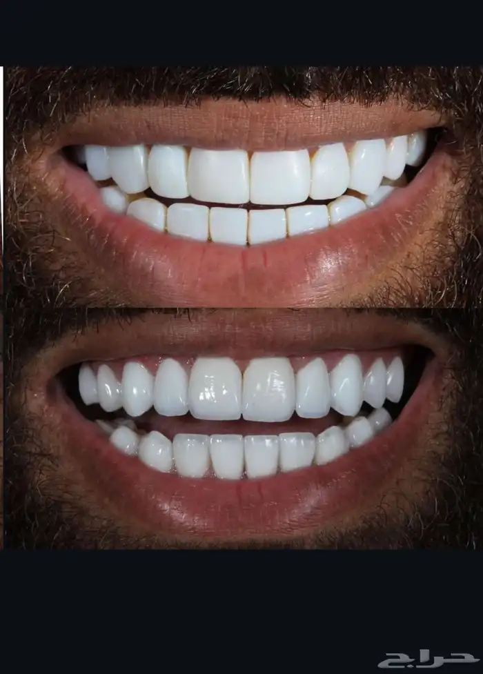 ابتسامة متحركة تجميلية 4