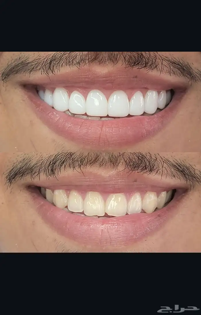 ابتسامة هوليود 1