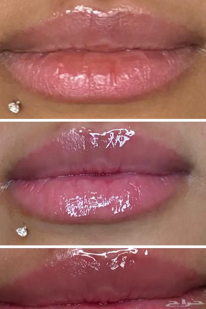 توريد الشفايف بتقنية المايكرو ونتائج تنافس العيادات 4