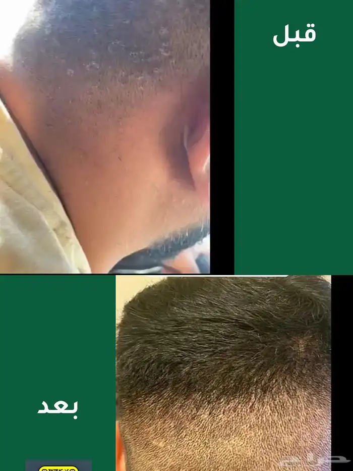 زيت بديل الديتوكس للقضاء على قشرة الرأس 2