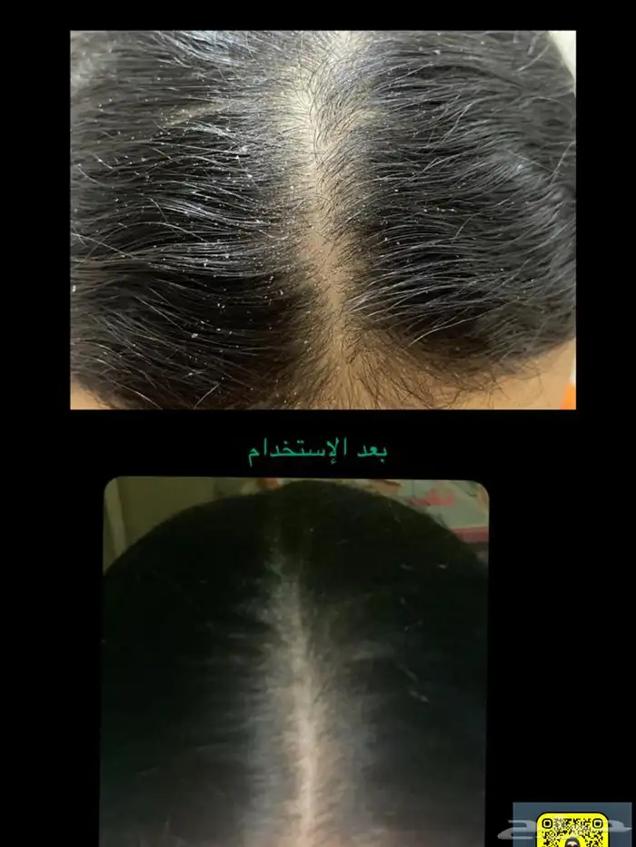 زيت بديل الديتوكس للقضاء على قشرة الرأس 1