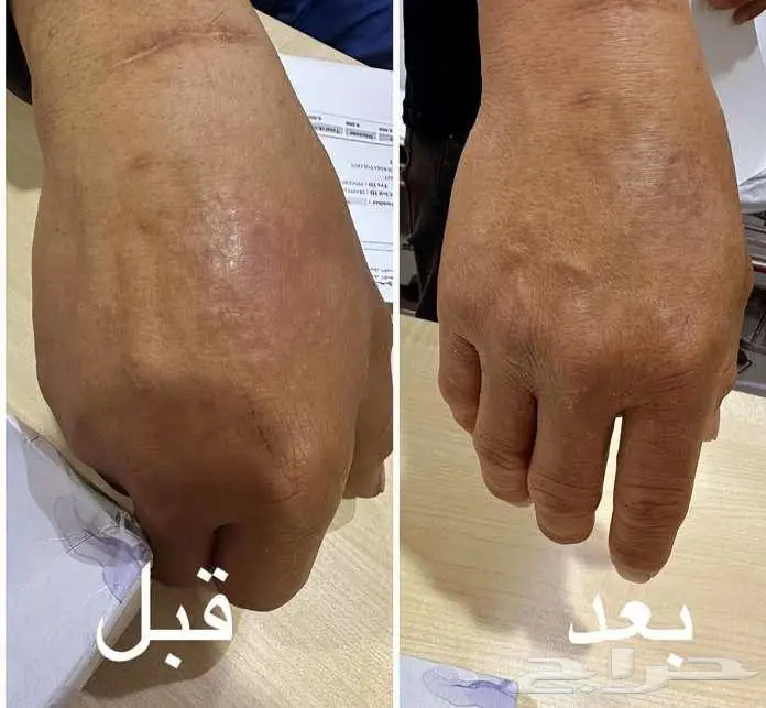 للتخلص من الصدفيه والاكزيما 1