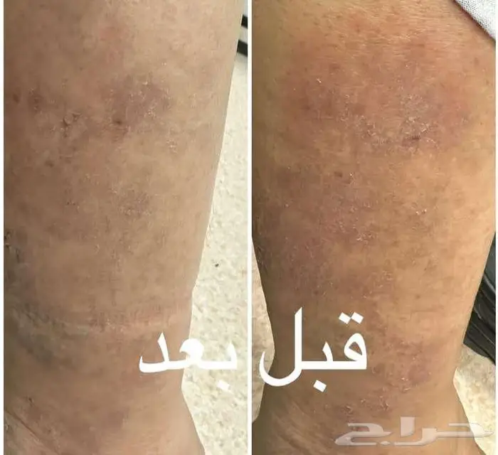 للتخلص من الصدفيه والاكزيما 0
