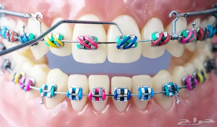 تقويم اسنان زينه 1