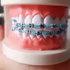 تقويم اسنان زينه 3