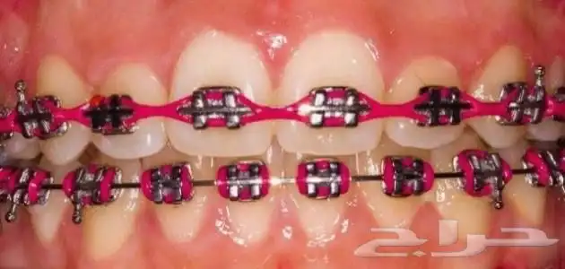 تقويم اسنان زينه 18