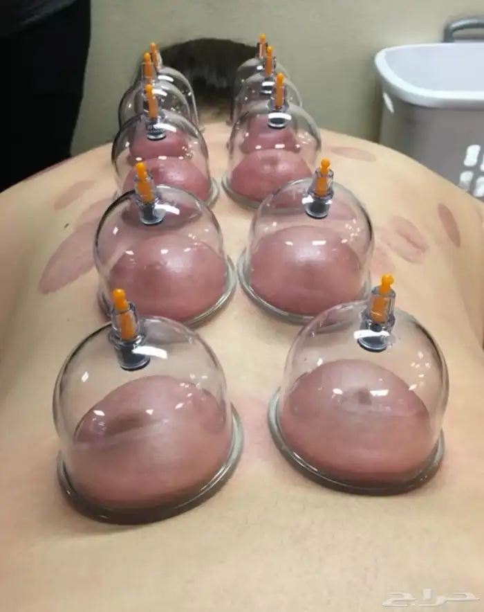 متخصص حجامة 0