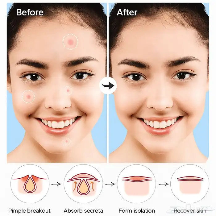 لصقات طبيه لعلاج الحبوب 2