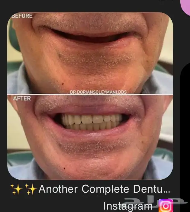 طقم اسنان كامل علوي وسفلي 1