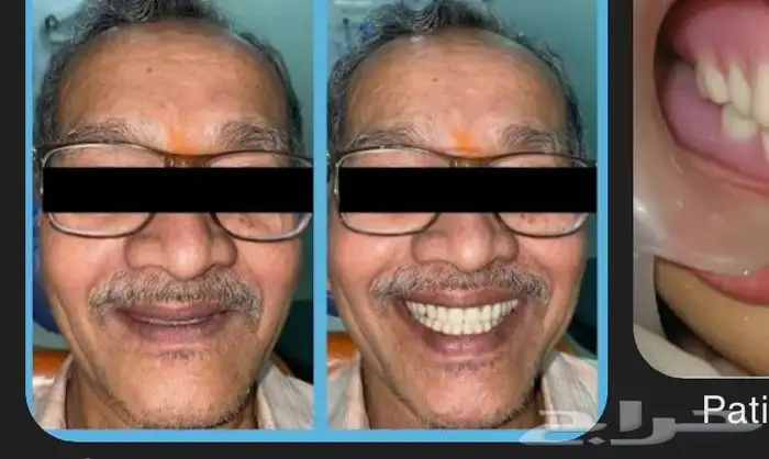 طقم اسنان كامل علوي وسفلي 0